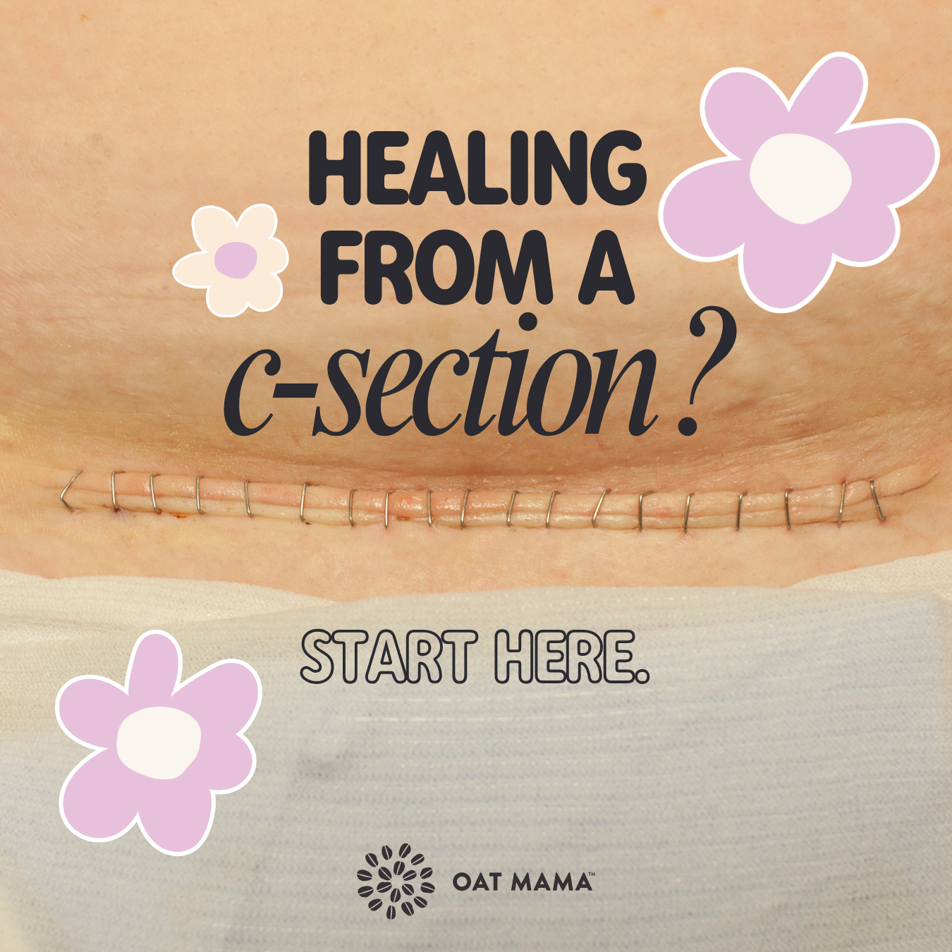 C-Section Recovery Is No Joke: Practical Tips for Healing After Birth